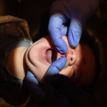 How Tongue Tie and Lip Tie Surgery Became a Big Business