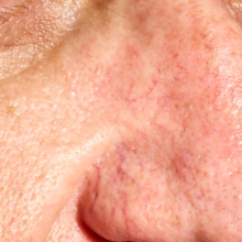 Can I Fix the Spider Veins on My Face?