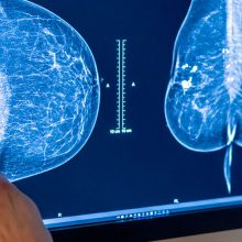 In Reversal, Expert Panel Recommends Breast Cancer Screening at 40