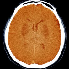 Unresponsive Brain-Damaged Patients May Have Some Awareness