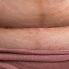 Why Is My C-Section Scar Painful, Itchy and Sometimes Smelly?